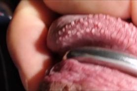 Perly Penile Papules